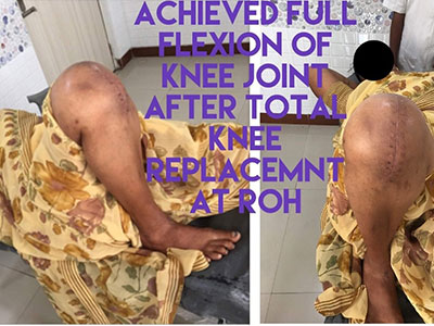 When to Consider Joint Replacement